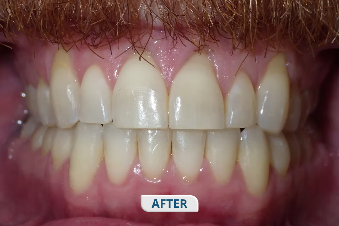 After treatment at Namira Oro Dental Care